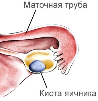 Киста на яичнике лечение в домашних условиях 275